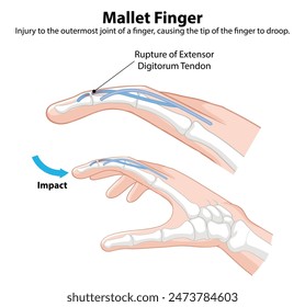 Diagram showing mallet finger injury details