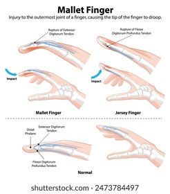 Diagram showing mallet and jersey finger injuries