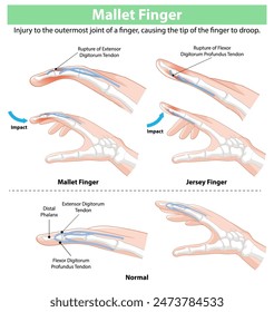 Diagram showing mallet and jersey finger injuries