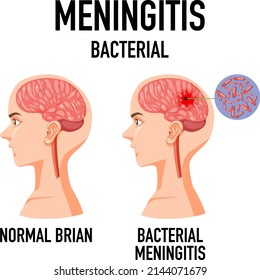 Diagram Showing Meningitis Bacterial Brain Illustration Stock Vector ...