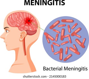 Diagram showing meningitis on human illustration