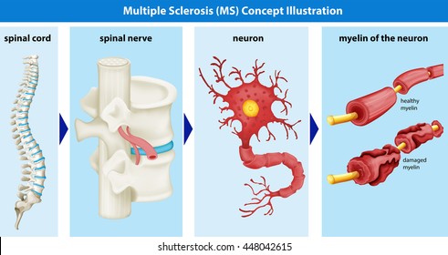 Diagram showing multiple sclerosis concept illustration