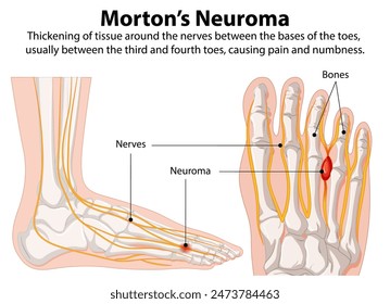 Diagram showing nerve thickening in the foot