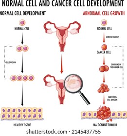 Diagram showing normal and cancer cells in human illustration