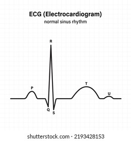 Diagram Showing Normal Heart Beat Wave Stock Vector (Royalty Free ...