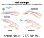 Diagram showing normal and mallet finger conditions