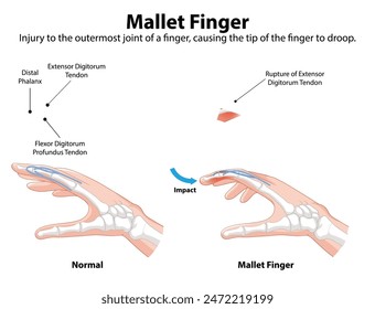 Diagram showing normal and mallet finger conditions