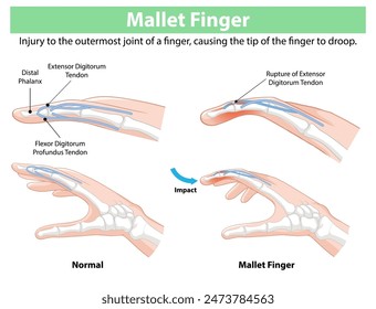 Diagram showing normal and mallet finger conditions