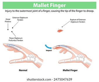 Diagram showing normal and mallet finger conditions