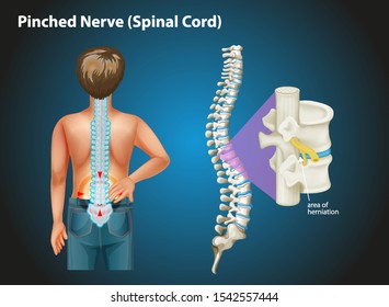 Diagram showing pinched nerve in human illustration