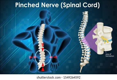 Diagram showing pinched nerve in human illustration