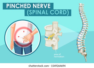 Diagram showing pinched nerve in human illustration