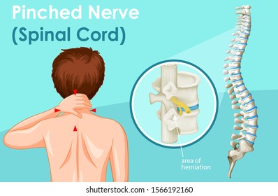 Diagram showing pinched nerve in human illustration