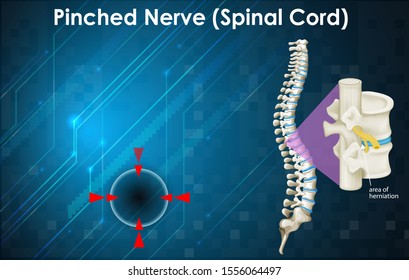 Diagram showing pinched nerve  illustration