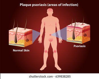 Diagram showing plaque psoriasis in human illustration