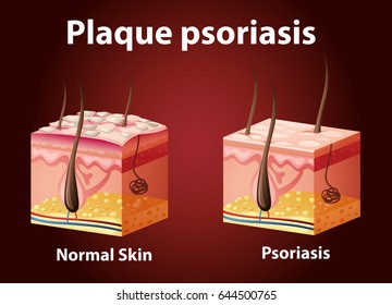 Diagram showing plaque psoriasis illustration