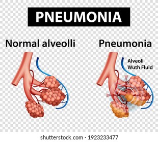 Diagram showing pneumonia on transparent background illustration