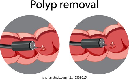 Diagram showing polyp removal illustration