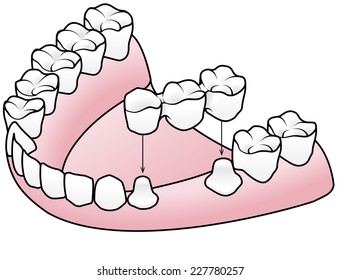 Diagram showing the process of fitting a prosthetic dental fixed bridge over two prepared teeth on either side of a missing tooth.