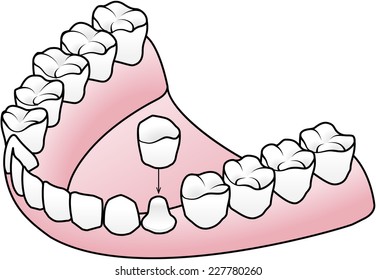 Diagram showing the process of fitting a prosthetic dental crown / cap over a prepared tooth.