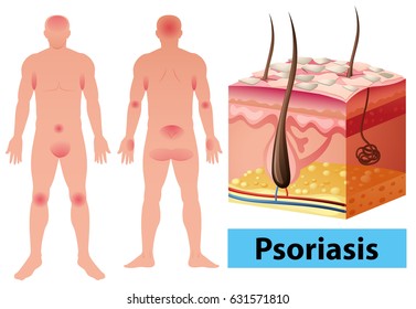 Diagram Showing Psoriasis In Human Illustration