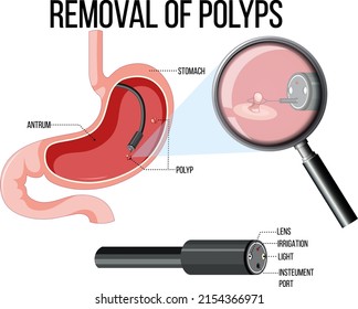 Diagram showing removal of polyps illustration
