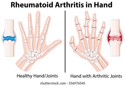 Diagram Showing Rheumatoid Arthritis In Hand Illustration