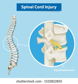 Diagram showing spinal cord injury illustration