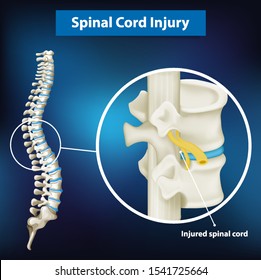 Diagram showing spinal cord injury illustration