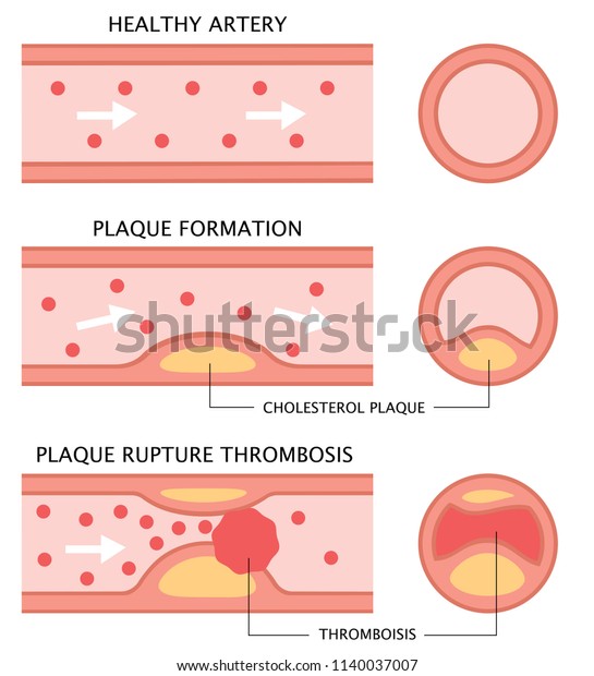 diagram showing stages of atherosclerosis in\
flat illustration. normal artery, accumulation of cholesterol in\
blood vessel, and blood clot\
formation