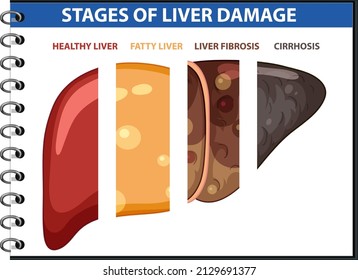 Diagram showing stages of liver damage illustration