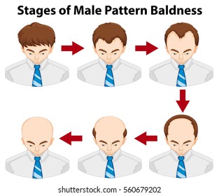 Balding Chart