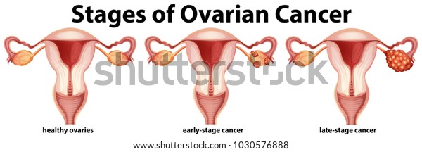 Diagram\
showing stages of ovarian cancer\
illustration