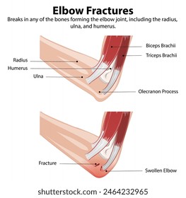 Diagrama que muestra los tipos de fracturas de codo