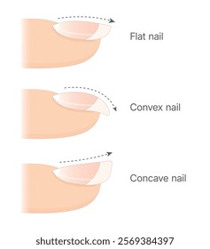 Diagram showing types of nail plate. Flat nail. Convex nail. Concave nail.