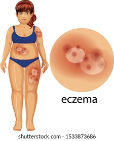 Diagram showing woman with eczema illustration
