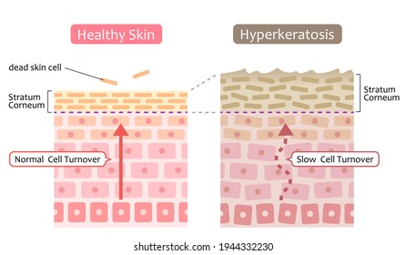 diagram of skin cell turnover and thickening of the stratum corneum. Skin care and beauty concept