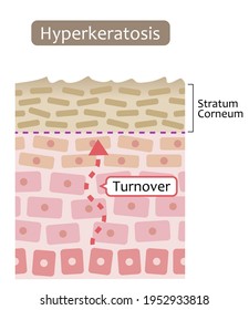 Diagram Of Skin Cell Turnover And Thickening Of The Stratum Corneum. Skin Care And Beauty Concept
