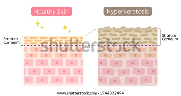 diagram of skin cell turnover and\
thickening of the stratum corneum. Skin care and beauty\
concept