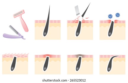 diagram of skin troubles caused by razor shaving