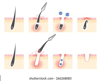 diagram of skin troubles caused by tweezing