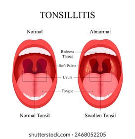 Diagram of Tonsillitis Causes, Normal Tonsils and Swollen Tonsils