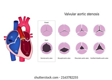 Diagram of valvular aortic stenosis (closed and open). 