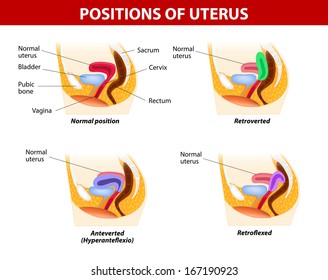 Diagram Variants Uterine Position Normal Uterus: immagine vettoriale