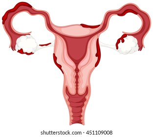 Diagram of woman ovary with endometriosis illustration