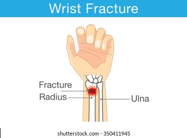 Diagram Of Wrist Have Bone Fracture