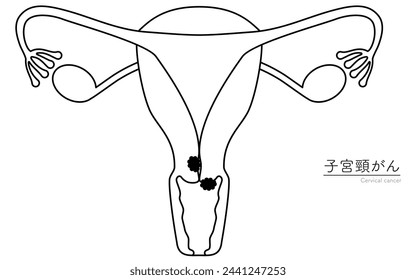Diagrammatic illustration of cervical cancer, anatomy of the uterus and ovaries, Vector Illustration