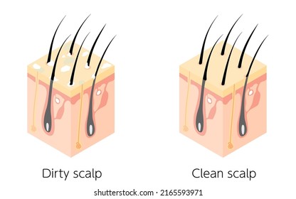 Diagrammatic illustration of a cross section of a dirty scalp and a clean scalp, isometric