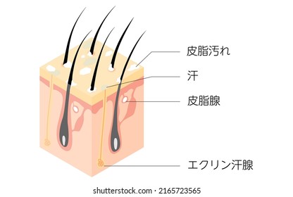 Diagrammatic illustration of a cross section of a dirty scalp, isometric - Translation: dirty scalp