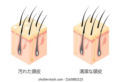 Diagrammatic illustration of a cross section of a dirty scalp and a clean scalp, isometric - Translation: dirty scalp, clean scalp